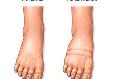 Que es un edema Que es un edema