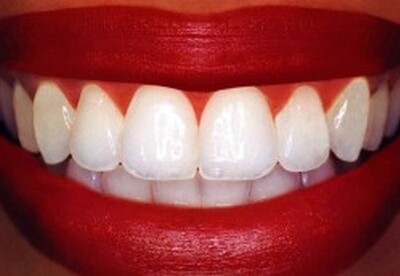 Dientes blancos Dientes blancos