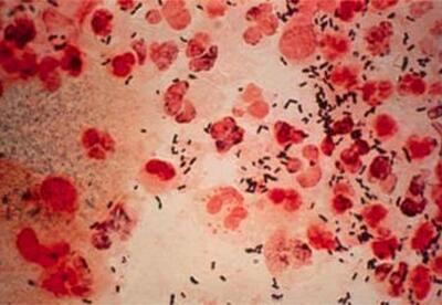 Gonorrea, enfermedad de transmisión sexual Gonorrea, enfermedad de transmisión sexual