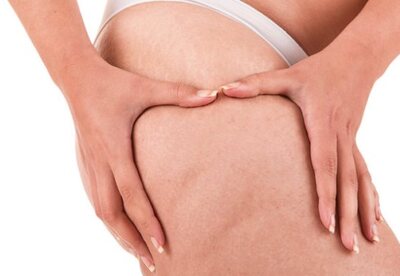 Celulitis Celulitis
