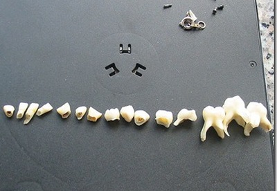 Endodoncia | Tratamiento de conductos radiculares Endodoncia | Tratamiento de conductos radiculares