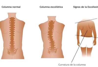 Síntomas y tratamiento de la escoliosis lumbar Síntomas y tratamiento de la escoliosis lumbar