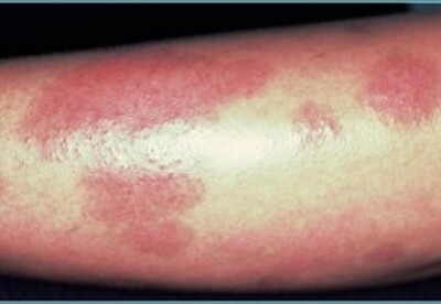 La psoriasis aumenta el riesgo de sufrir un ictus cerebral La psoriasis aumenta el riesgo de sufrir un ictus cerebral