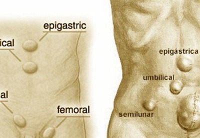 Que es una hernia Que es una hernia