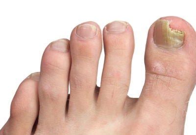 Cómo combatir una infección de uñas Cómo combatir una infección de uñas