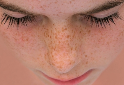 ¿Cómo librarse de las pecas del rostro? ¿Cómo librarse de las pecas del rostro?