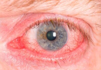 Ojos rojos Ojos rojos