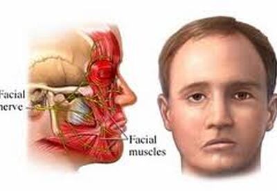 Parálisis facial: causas y su tratamiento Parálisis facial: causas y su tratamiento
