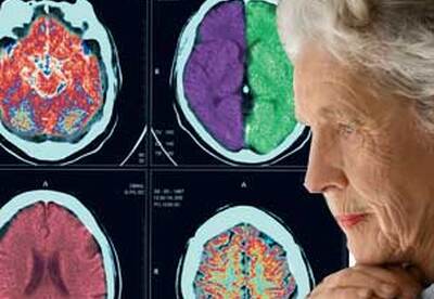 Habilidad de montar bicicleta ayuda a diagnosticar Parkinson Habilidad de montar bicicleta ayuda a diagnosticar Parkinson