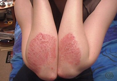 La psoriasis crece junto con el estrés La psoriasis crece junto con el estrés
