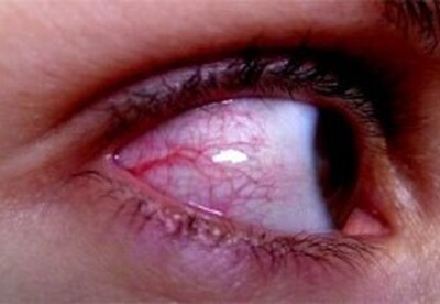 Remedios ojos rojos Remedios ojos rojos