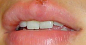 Remedios caseros para herpes Remedios caseros para herpes