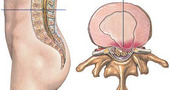 Hernia discal, como aliviar sÃntomas Hernia discal, como aliviar sÃntomas