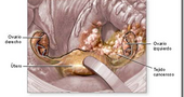 Cancer de Ovario, mejoran el diagnostico