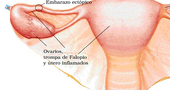 Embarazo ectópico Embarazo ectópico