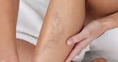 Varices Varices