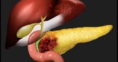 Avances en terapia contra cáncer pancreático Avances en terapia contra cáncer pancreático