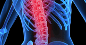 Osteoporosis, el mal de los huesos frágiles que casi nadie cree padecer Osteoporosis, el mal de los huesos frágiles que casi nadie cree padecer