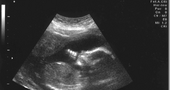 Ultrasonidos en el Embarazo