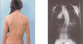 Ejercicios para la escoliosis Ejercicios para la escoliosis