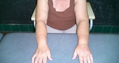 Linfedema, problema posterior al cáncer de mamas Linfedema, problema posterior al cáncer de mamas