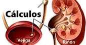 Cálculos renales bajo la lupa Cálculos renales bajo la lupa