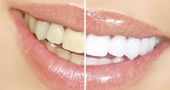 ¿Cómo librarse de las manchas dentales?