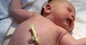 Cordon umbilical bebé recien nacido Cordon umbilical bebé recien nacido
