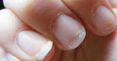 Cuidado de las uñas quebradizas de manera natural