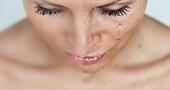 Elimina las manchas de la cara en tres sesiones