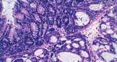 Las células tumorales de colon que producen metástasis en el hígado se vuelven más agresivas