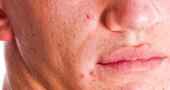 Lavado facial para el acné y rosácea según nuestra piel