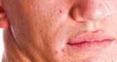 Lavado facial para el acné y rosácea según nuestra piel Lavado facial para el acné y rosácea según nuestra piel