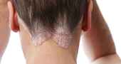 Psoriasis en el cuero cabelludo causas y tipos de tratamientos