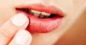 Remedios para curar el herpes labial naturalmente
