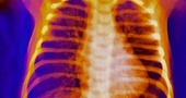 Sindrome de Tietze Sindrome de Tietze