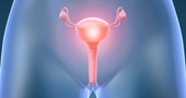 Tratamiento natural para la fibrosis uterina