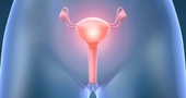 Tratamiento natural para la fibrosis uterina Tratamiento natural para la fibrosis uterina