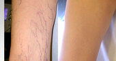 Tratamiento para las várices en las piernas Tratamiento para las várices en las piernas