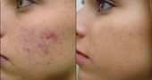 Cómo curar el acné