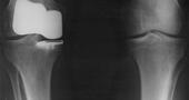 Maneras más habituales de provocarnos una lesión de ligamentos en la rodilla Maneras más habituales de provocarnos una lesión de ligamentos en la rodilla