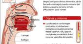 Sintomas de Faringitis Sintomas de Faringitis
