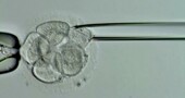 Biopsia de endometrio Biopsia de endometrio