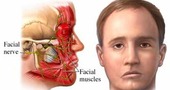 Paralisis facial Paralisis facial