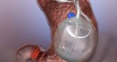 Peligros y riesgos del balón intragastrico