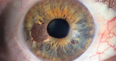 Nuevos tratamientos del cáncer de ojo