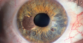 Nuevos tratamientos del cáncer de ojo Nuevos tratamientos del cáncer de ojo