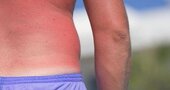 El peligro de los rayos del sol El peligro de los rayos del sol