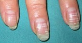 Leuconiquia: manchas blancas en las uñas Leuconiquia: manchas blancas en las uñas