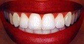 Dientes blancos Dientes blancos